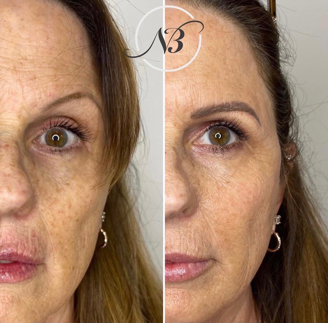 Morpheus8 Full Face Package